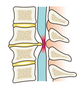 椎間板ヘルニア