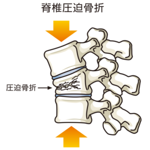 脊椎圧迫骨折のイラスト