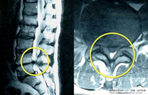 脊柱管狭窄症のMRI画像